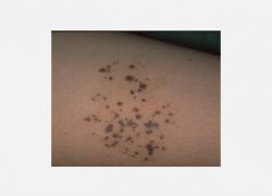 Nevus Spilus