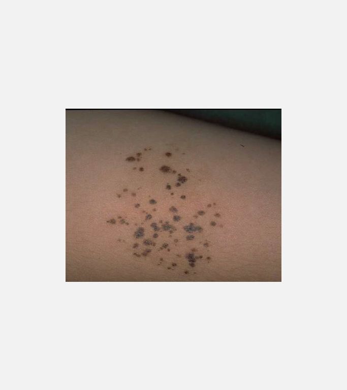 Nevus Spilus