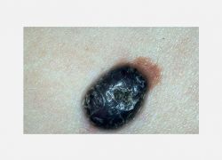 Nodular melanoma