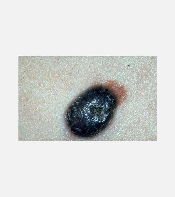 Nodular melanoma