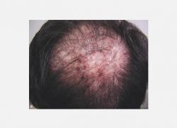 Folliculitis decalvans