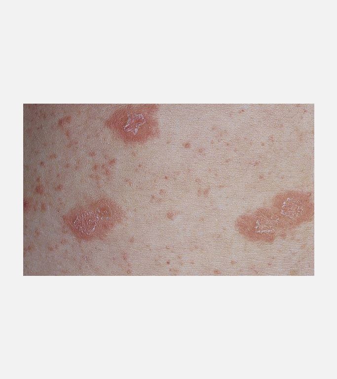 Pityriasis rozea tipik döküntüler ve yakalık belirtisi