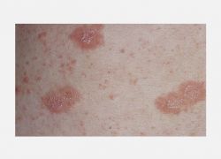 Pityriasis rozea tipik döküntüler ve yakalık belirtisi