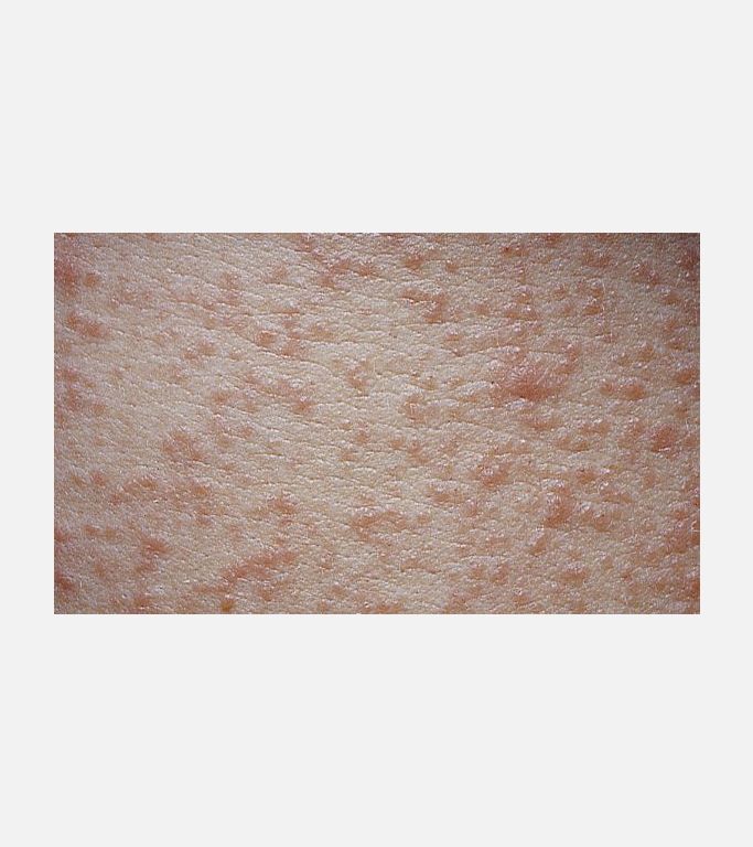 Pityriasis Rozea papüller formu