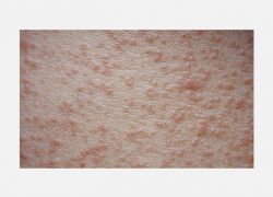 Pityriasis Rozea papüller formu