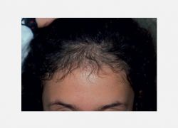 Traksiyonel-çekme Alopesi