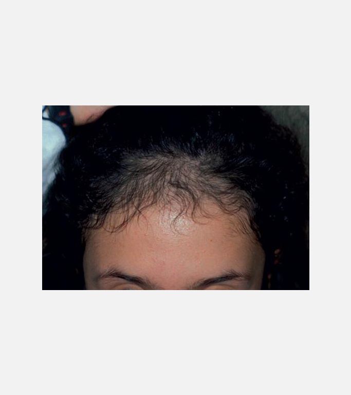 Traksiyonel-çekme Alopesi