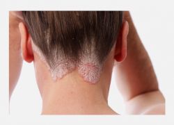 Saçlı deri-scalp psoriasis