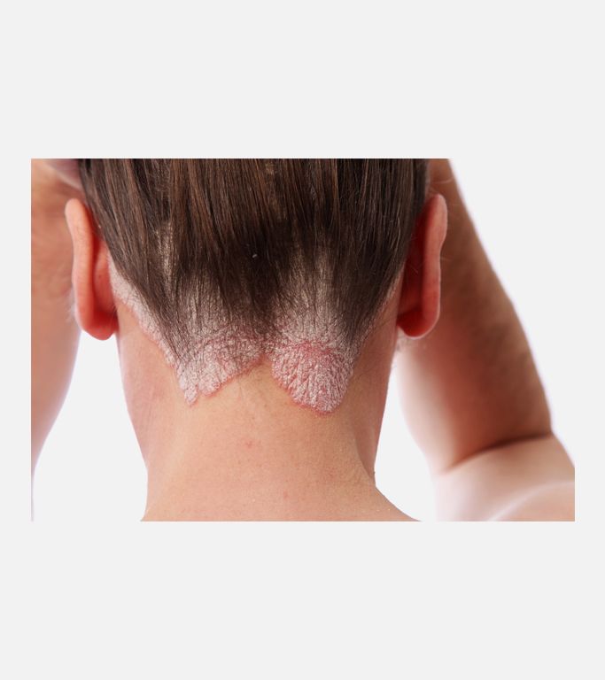 Saçlı deri-scalp psoriasis