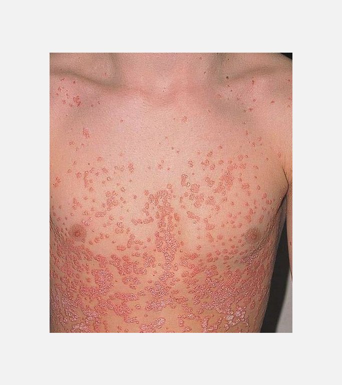 Guttate psoriasis(Damlacık Tarzı Sedef)