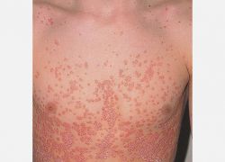 Guttate psoriasis(Damlacık Tarzı Sedef)