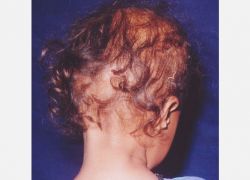 Ektodermal Dysplasia