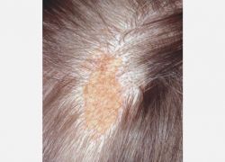 Epidermal Nevus