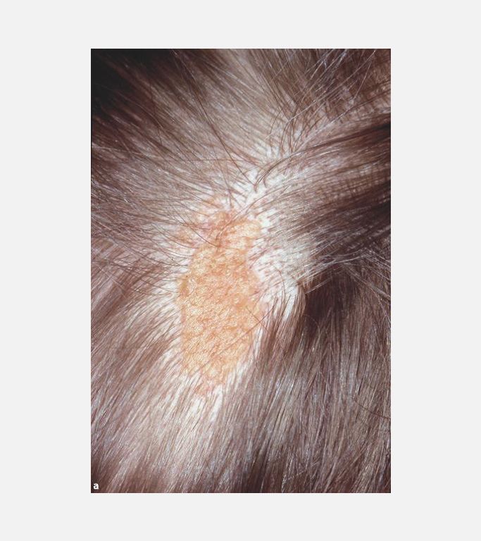 Epidermal Nevus