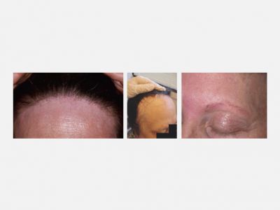 Frontal fibrosing alopecia