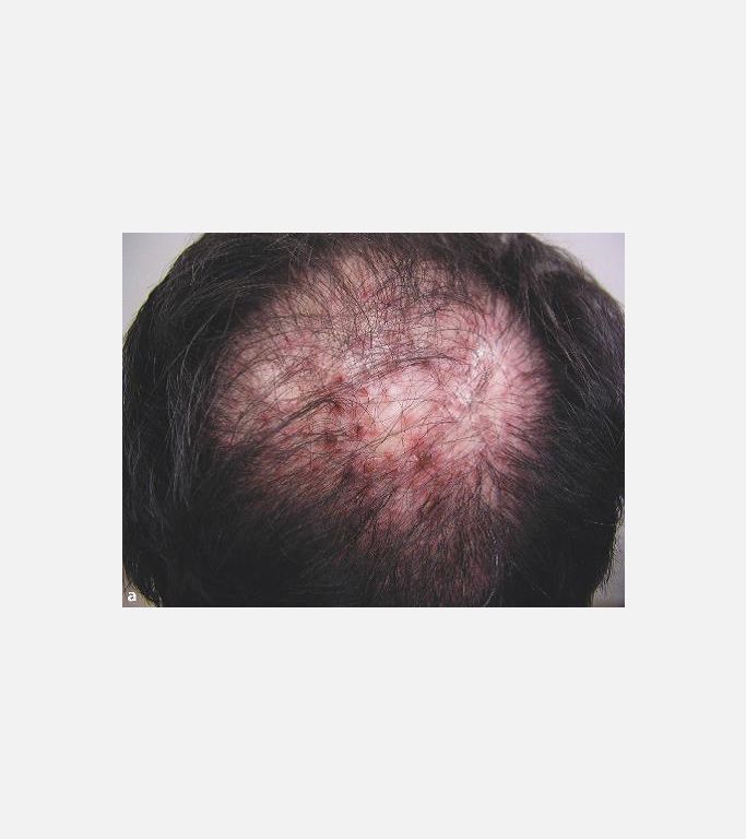 Folliculitis decalvans