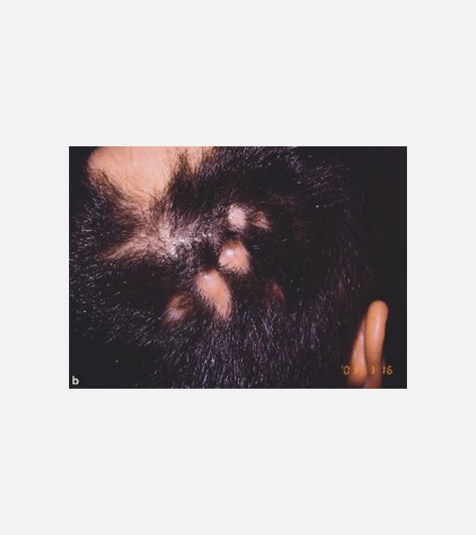 Perifolliculitis capitis abscedens et suffodiens