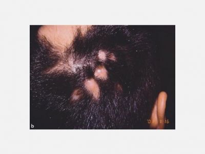 Perifolliculitis capitis abscedens et suffodiens