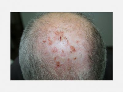 Erosive pustular dermatosis of the scalp