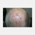 Erosive pustular dermatosis of the scalp