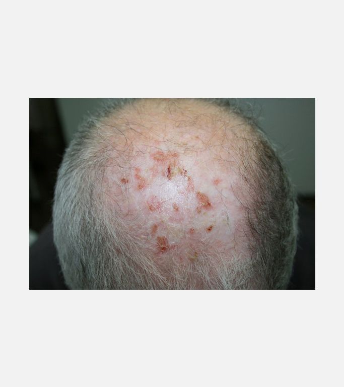 Erosive pustular dermatosis of the scalp