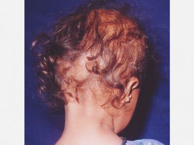 Ektodermal Dysplasia