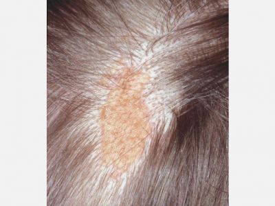 Epidermal Nevus