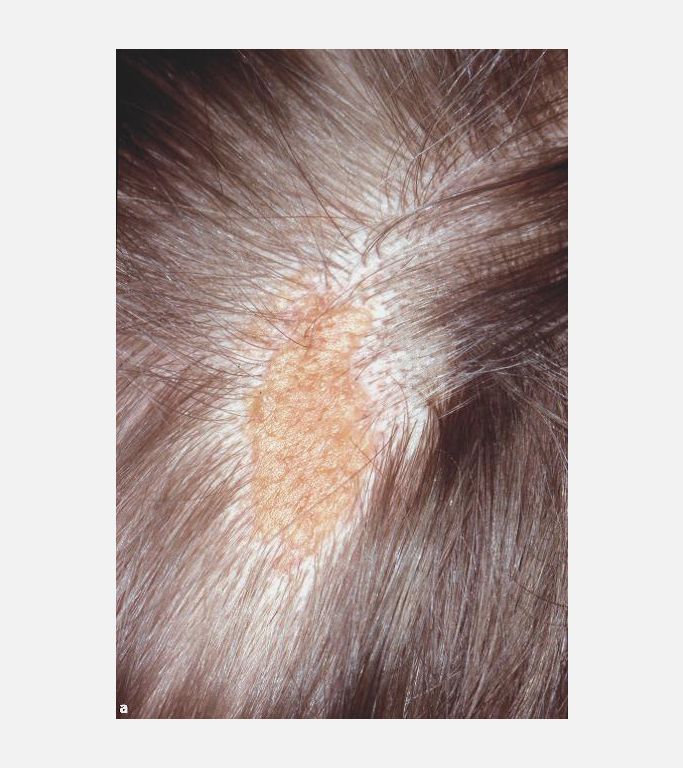 Epidermal Nevus