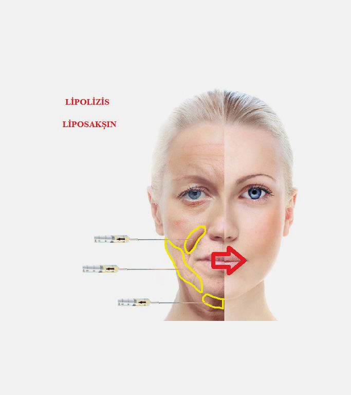 Lipolizis