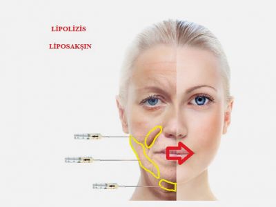 Lipolizis